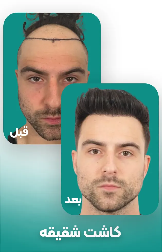 کاشت مو شقیقه در مردان