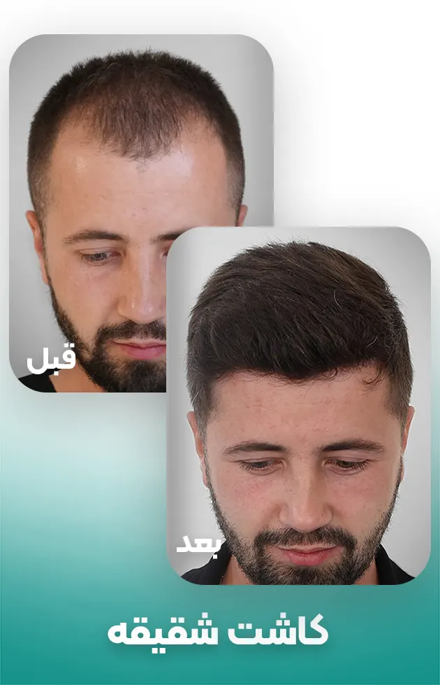 کاشت مو شقیقه در مردان