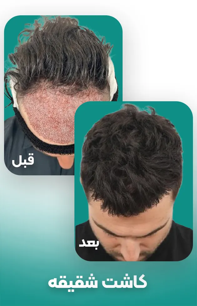 کاشت مو شقیقه در مردان