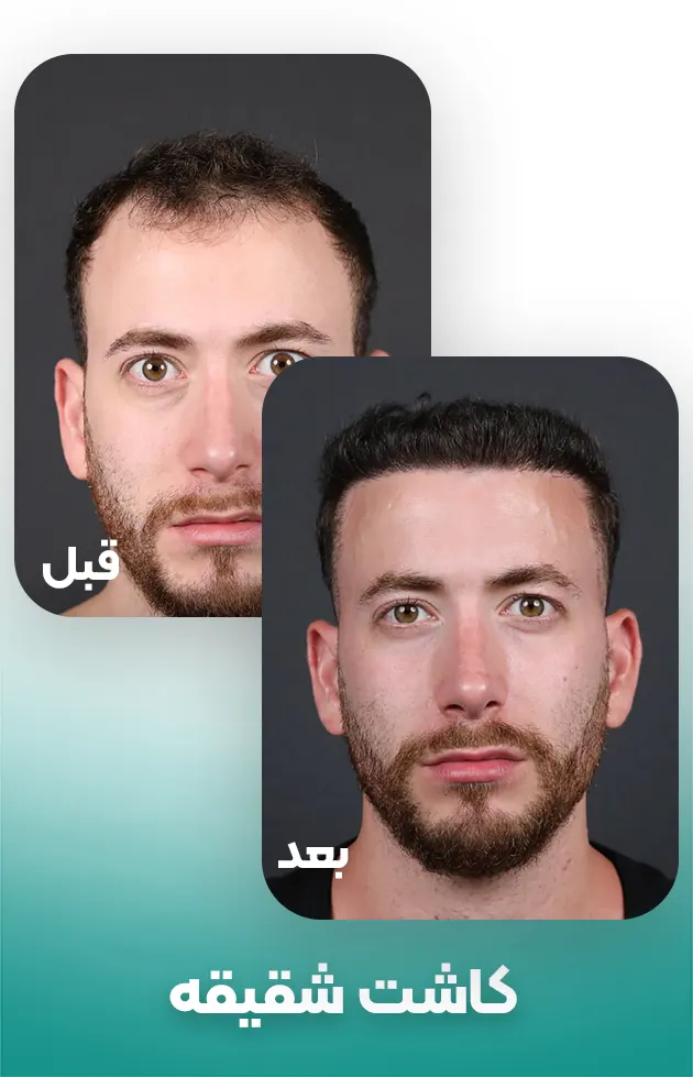 کاشت مو شقیقه در مردان