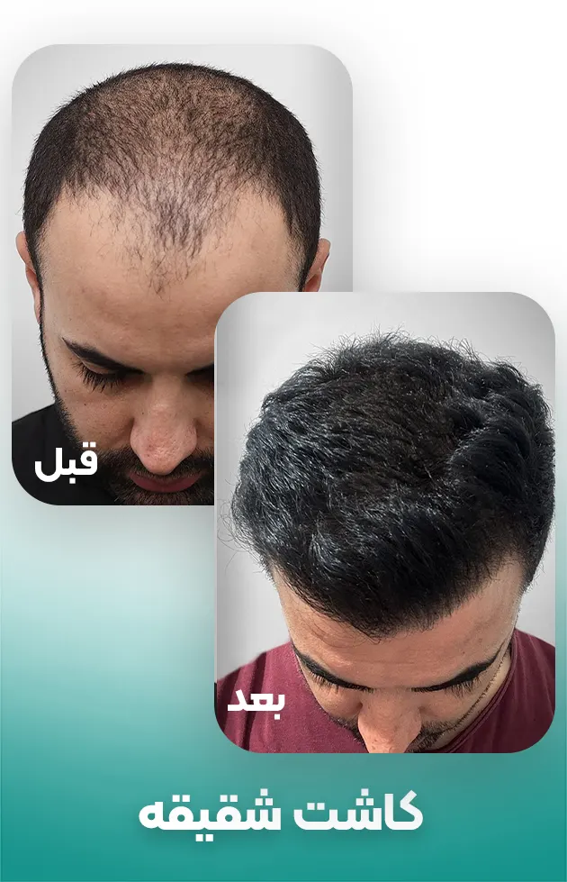 کاشت مو شقیقه در مردان