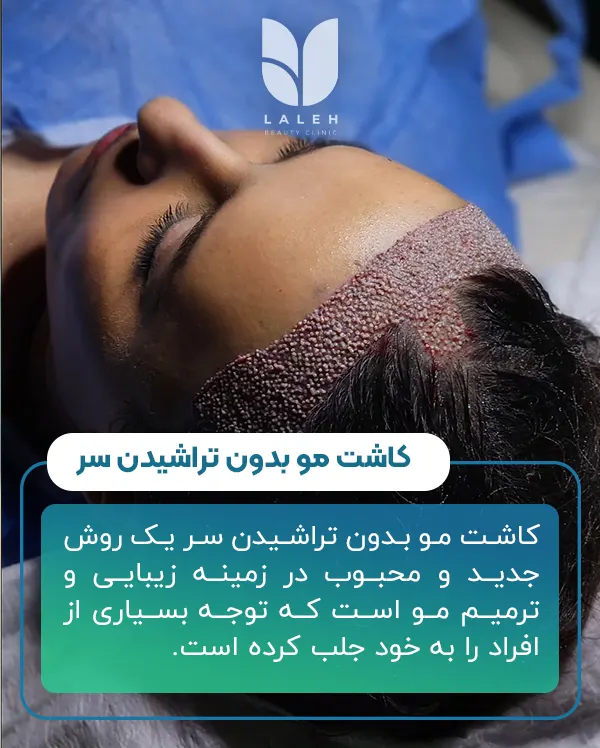 کاشت مو بدون تراشیدن سر