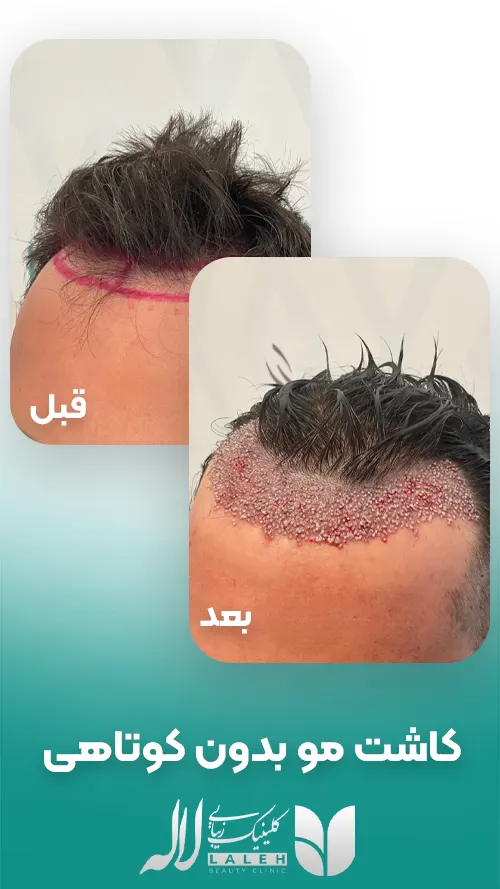 کاشت مو بدون کوتاهی
