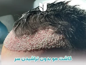 کاشت مو بدون تراشیدن سر