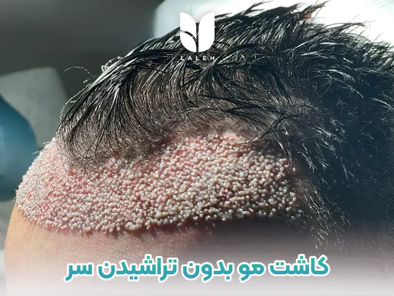 کاشت مو بدون تراشیدن سر