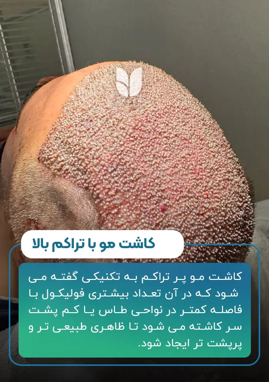 کاشت مو پر تراکم