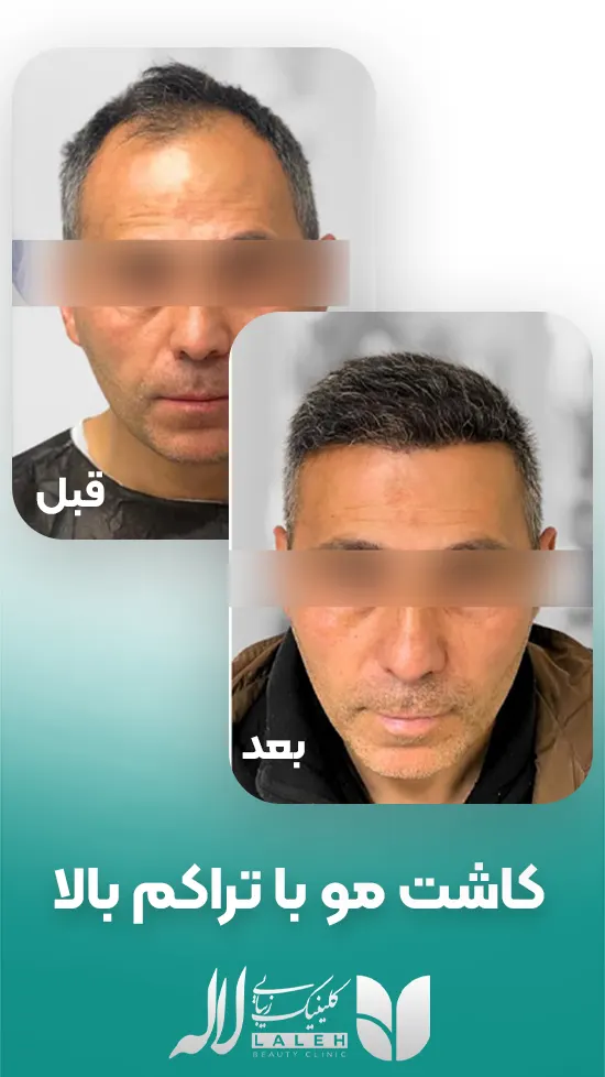 کاشت مو با تراکم بالا