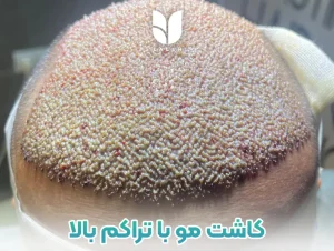 کاشت مو پر تراکم