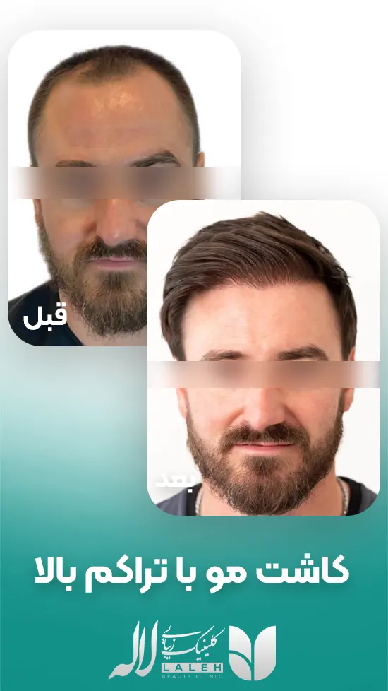 کاشت مو با تراکم بالا
