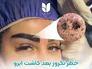 خطر نکروز بعد کاشت ابرو