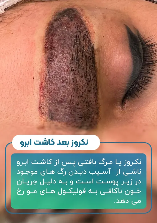 نکروز بعد کاشت ابرو