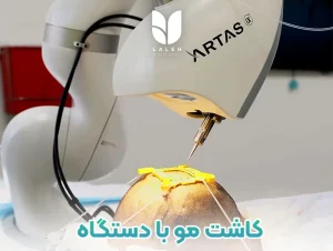 کاشت مو با دستگاه