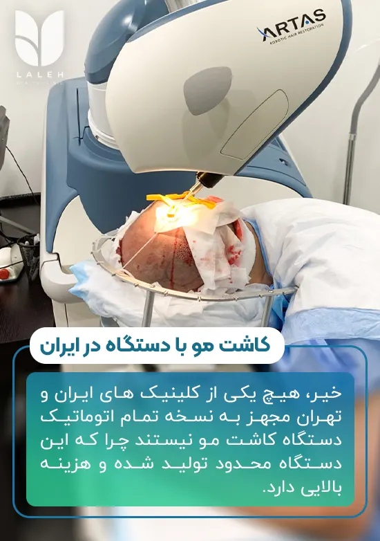 کاشت مو با دستگاه در ایران