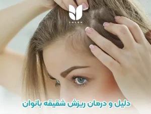 ریزش موی شقیقه در زنان