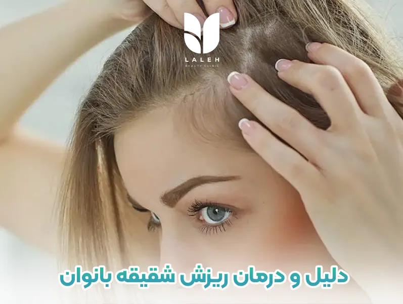 ریزش موی شقیقه در زنان