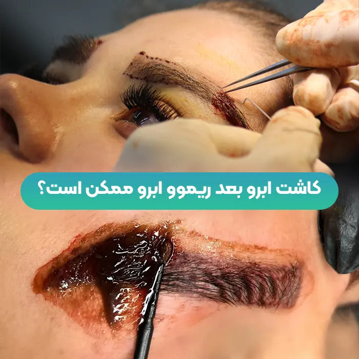 کاشت ابرو بعد ریموو ابرو