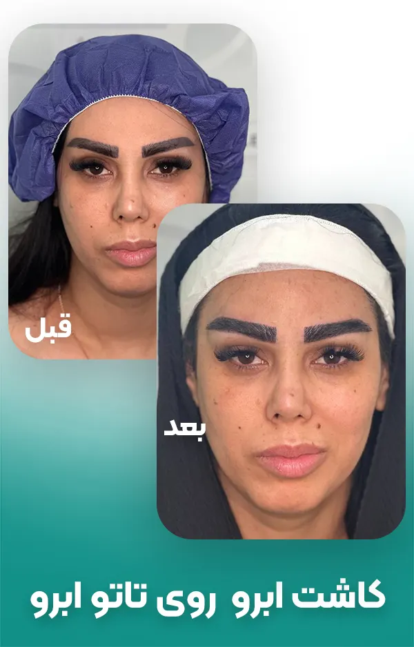 کاور تاتو ابرو با کاشت ابرو