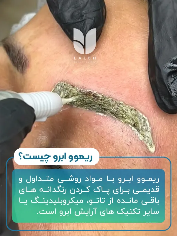 ریموو ابرو با مواد