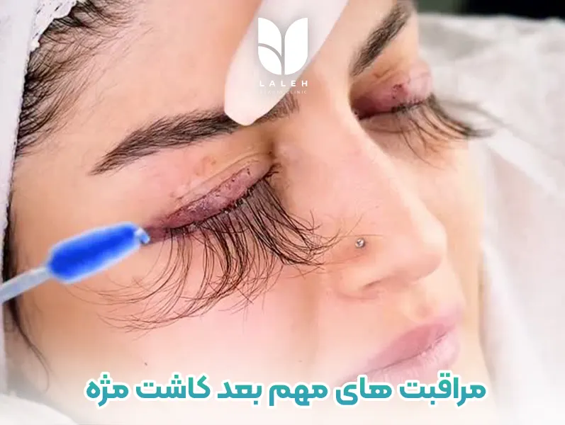مراقبت های مهم بعد از جراحی کاشت مژه دائمی
