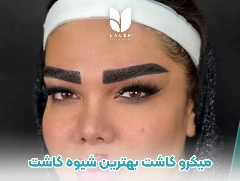 میکرو کاشت ابرو