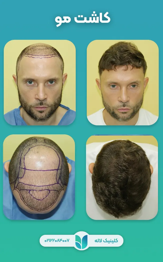 کاشت مو به روش میکروگرافت