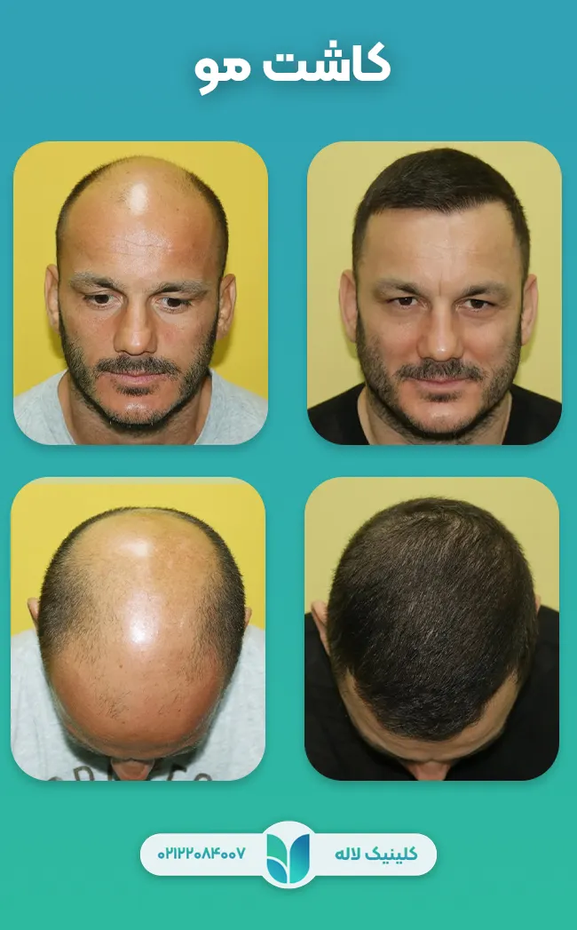 کاشت مو به روش میکروگرافت