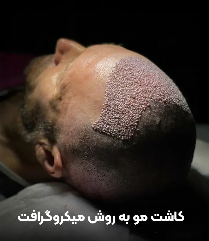 کاشت مو به روش میکروگرافت