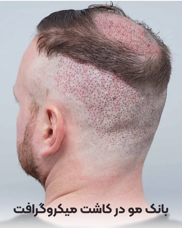 بانک مو در میکروگرافت