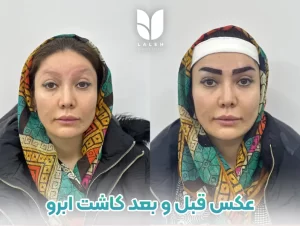 عکس قبل و بعد کاشت ابرو