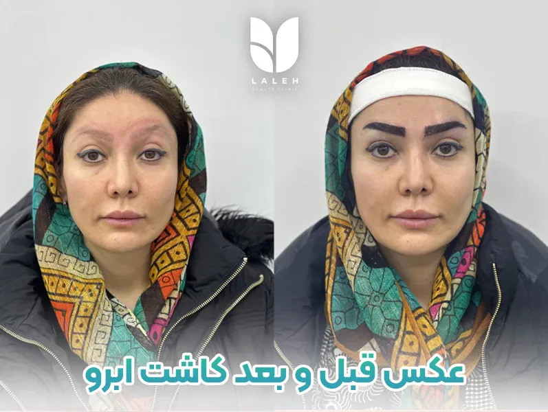 عکس قبل و بعد کاشت ابرو