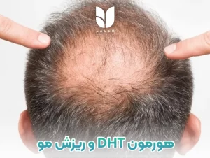 چرا هورمون دی هیدرو تستوسترون باعث ریزش مو می شود؟