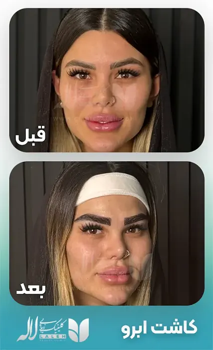 Eyebrow-transplant-02 copy