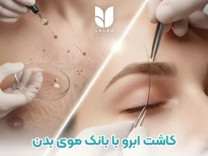 کاشت ابرو با موی بدن