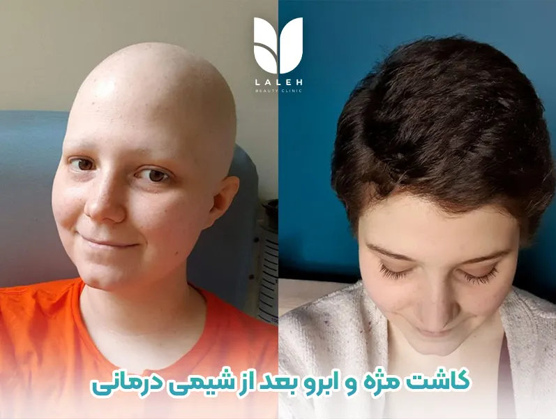 کاشت مژه و ابرو بعد از شیمی درمانی