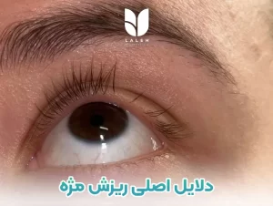 دلایل اصلی ریزش مژه