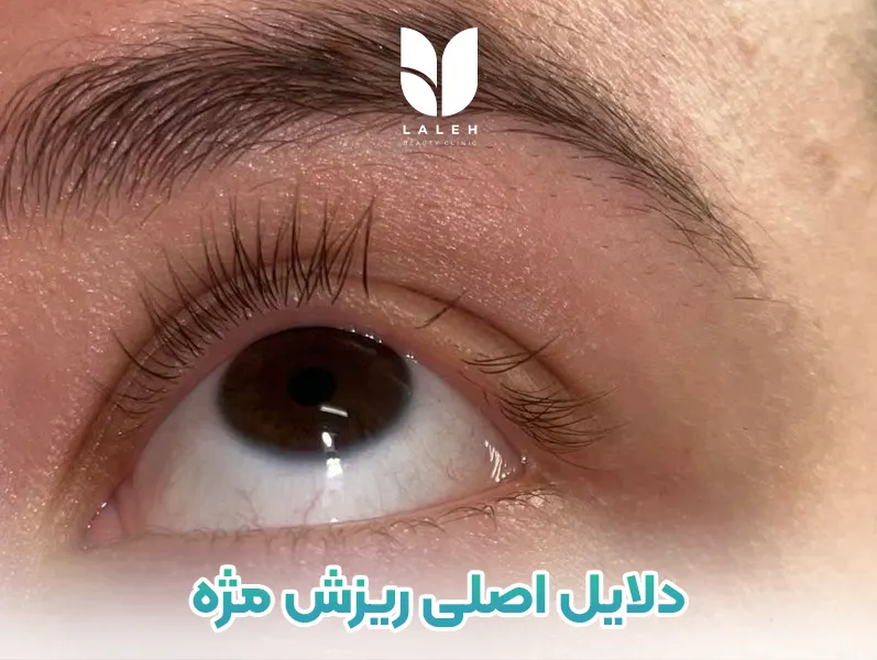 دلایل اصلی ریزش مژه