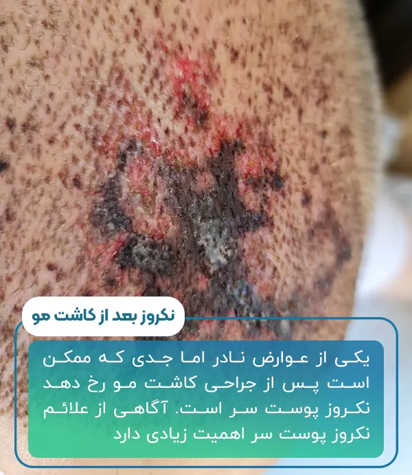 نکروز بعد از کاشت مو