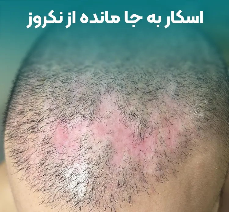 اسکار نکروز بعد از کاشت مو