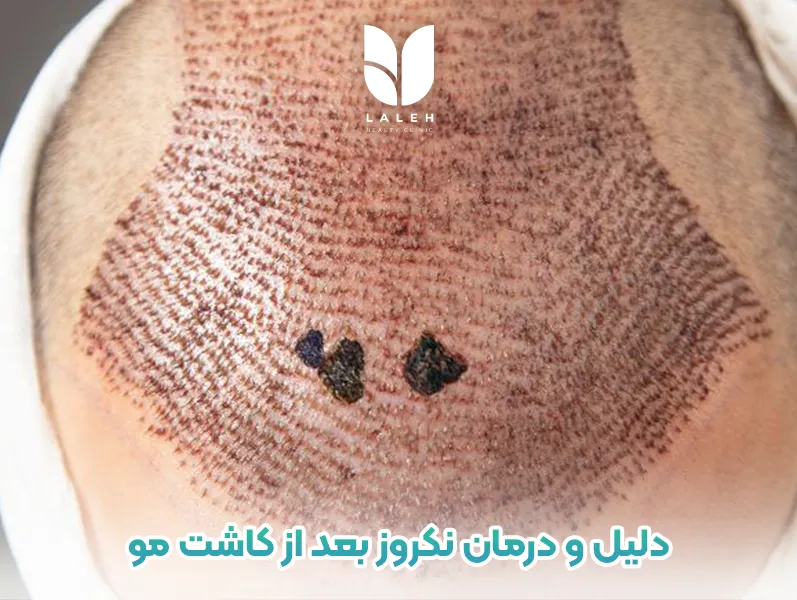 نکروز بعد از کاشت مو