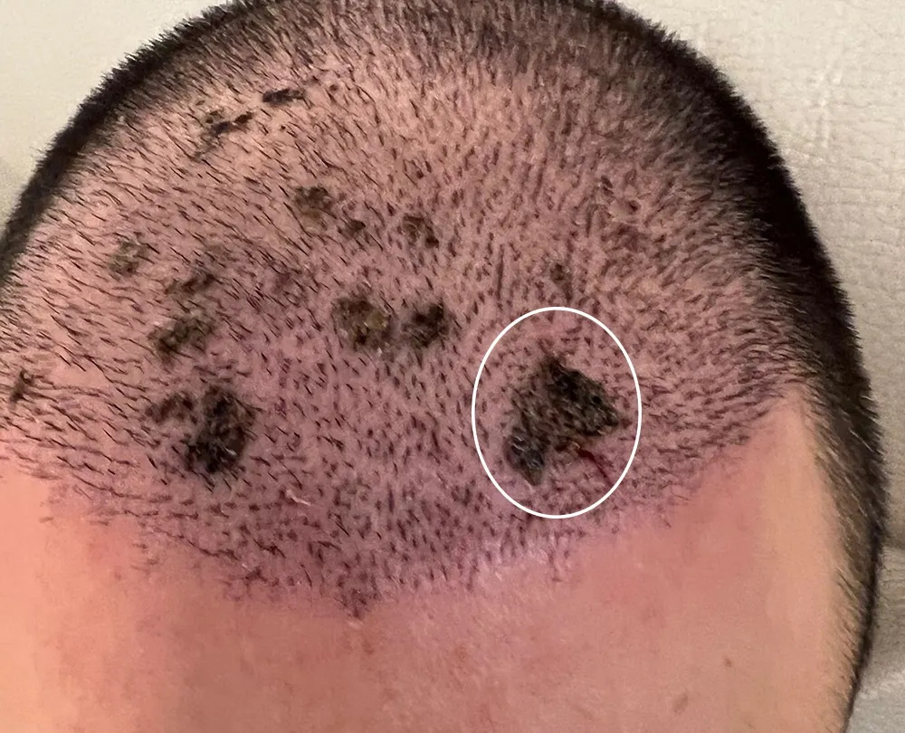 نکروز بعد از کاشت مو