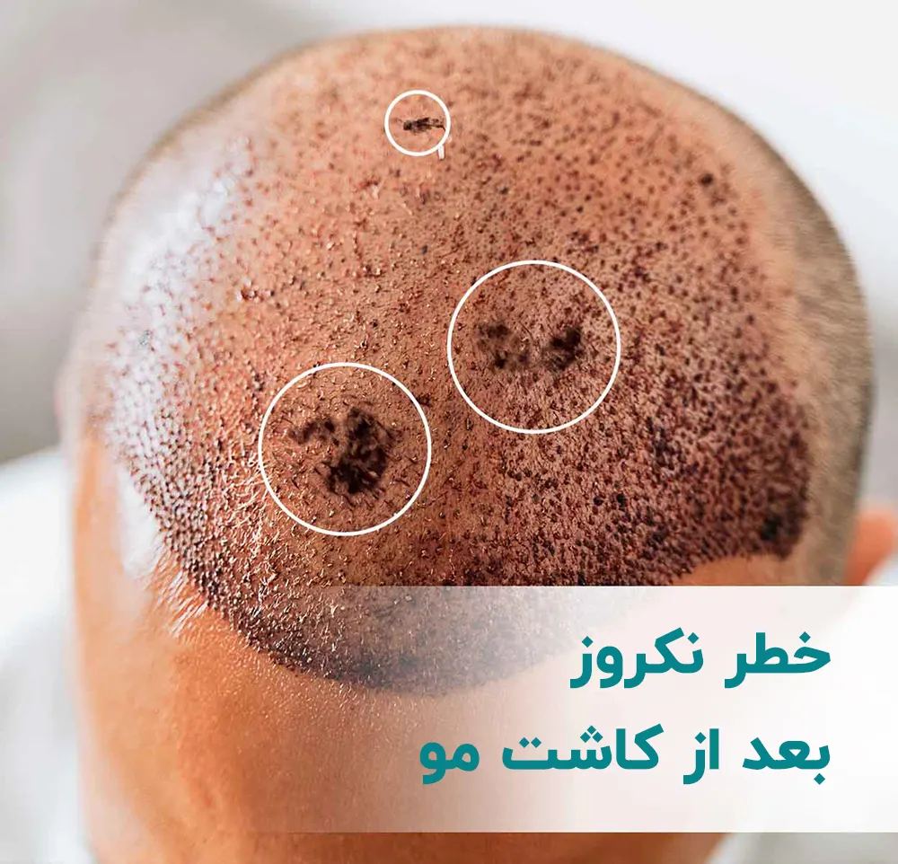 نکروز بعد از کاشت مو