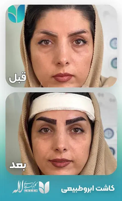 Natural-eyebrow-transplant-1