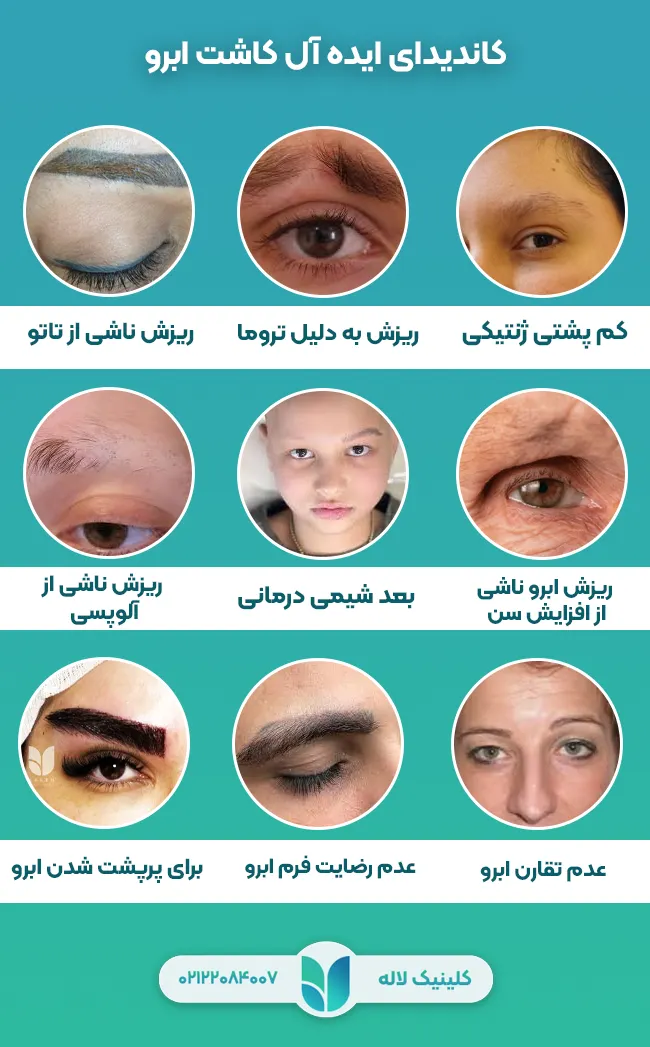 کاندیدا مناسب برای کاشت ابرو