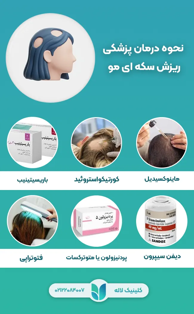 نحوه درمان پزشکی ریزش سکه ای مو