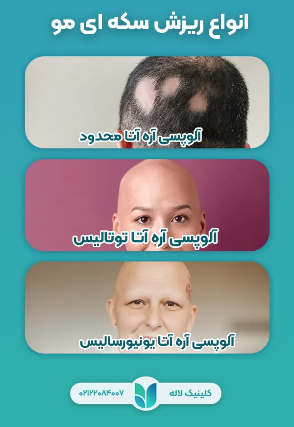 انواع ریزش سکه ای مو