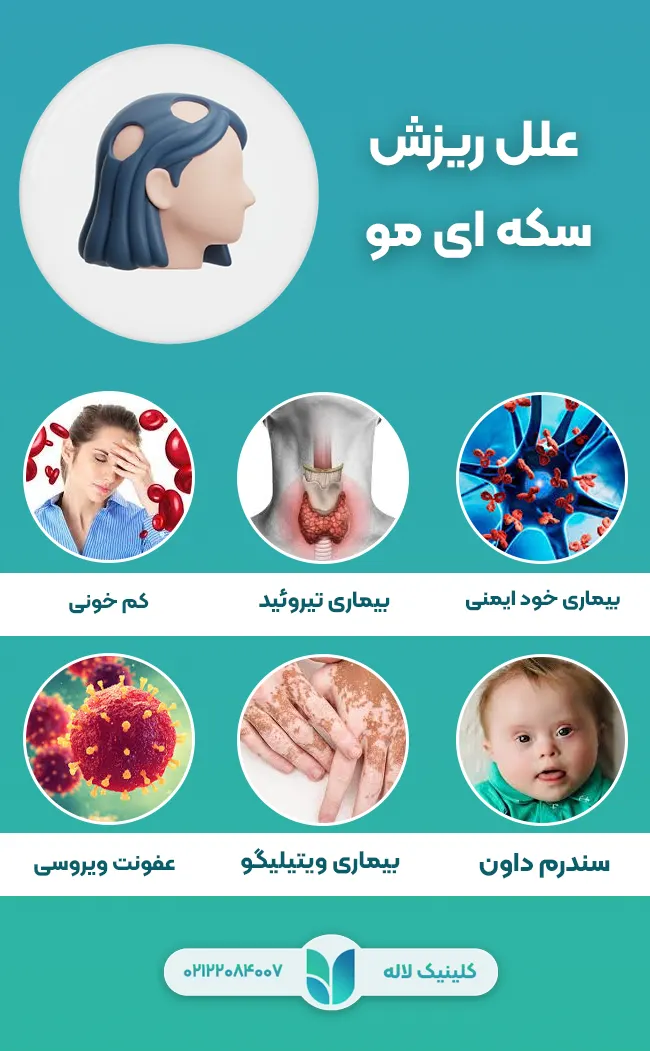 علل ریزش سکه ای مو