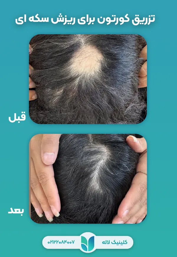 درمان قطعی ریزش سکه ای مو
