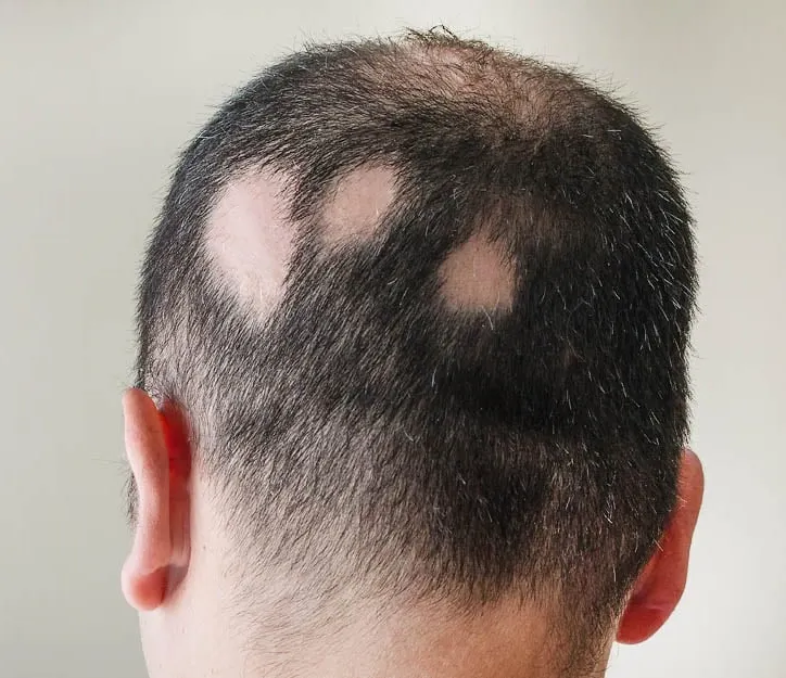 ریزش سکه ای مو