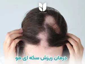 درمان ریزش سکه ای مو