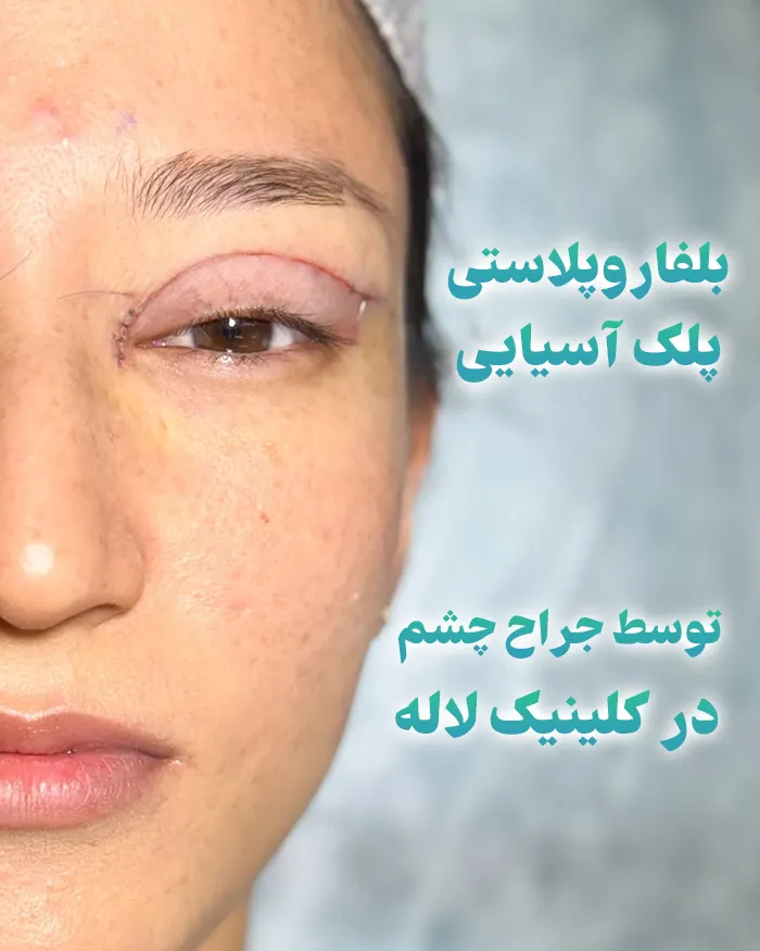 بلفاروپلاستی پلک آسیایی
